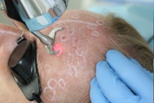 Cheratosi Attinica: cura con terapia fotodinamica - cheratosiattinica.it